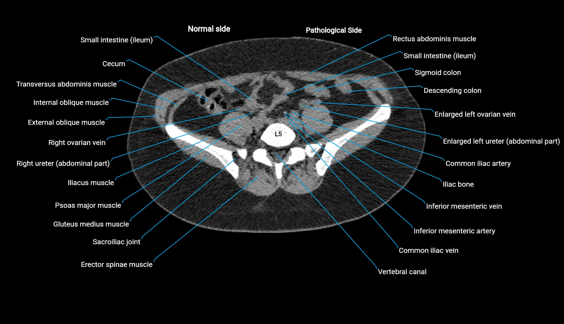 CT KUB axial cross sectional anatomy  radiology image -img-00201-00106.webp